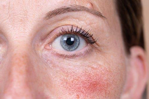 Rosacea